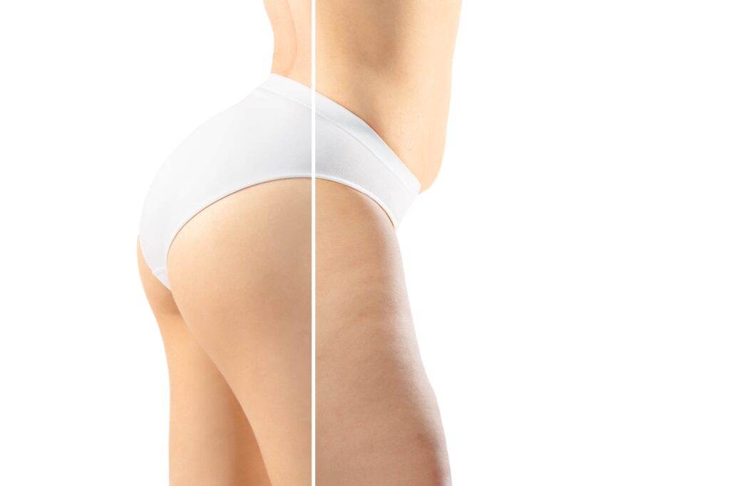 Anti-cellulite à Saint-Louis